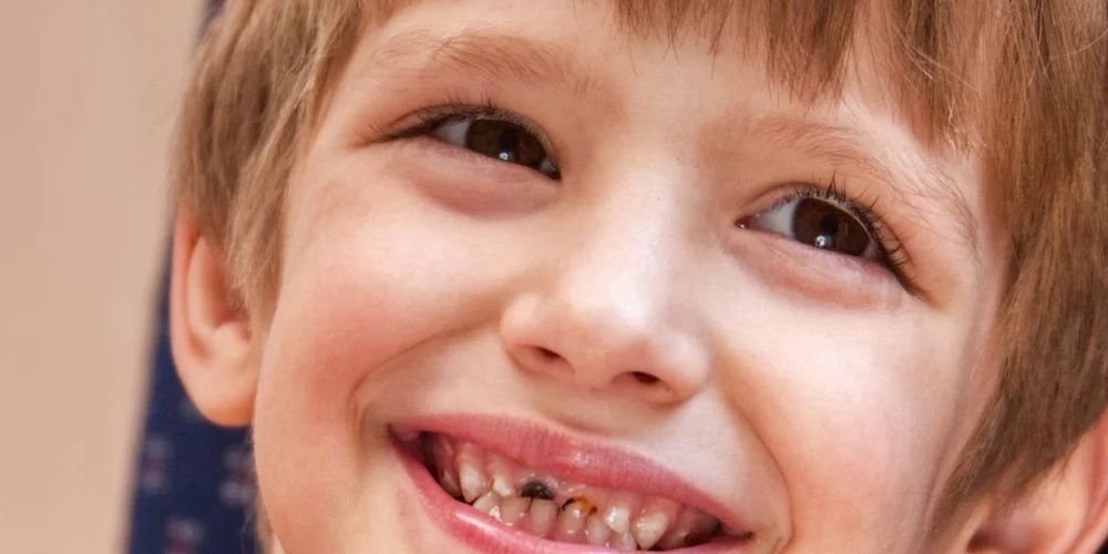 چرا قطره آهن باعث سیاهی دندان می شود ؟