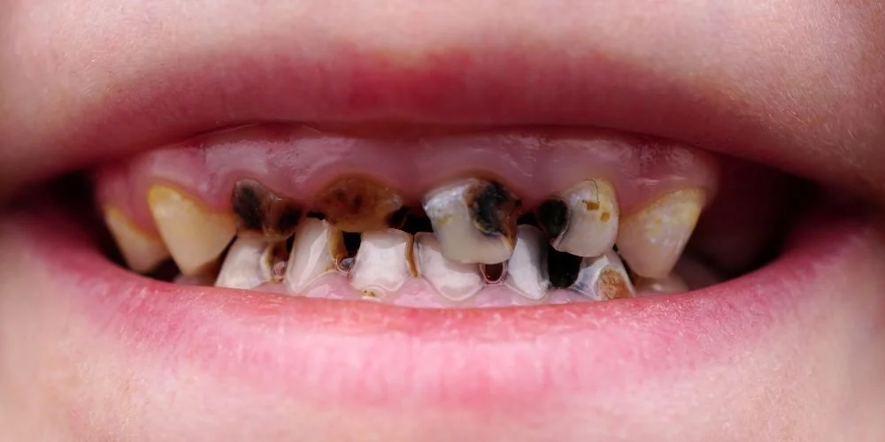 سیاه شدن دندان با قطره آهن لیپوزوفر 